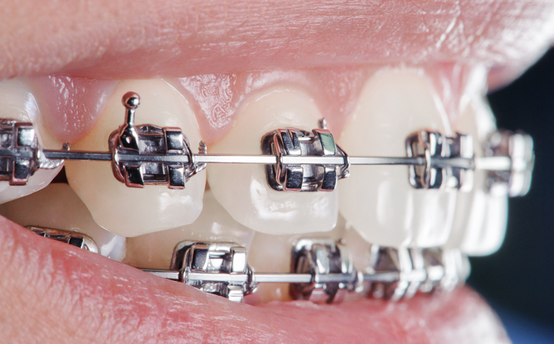 ortodoncia en dientes 