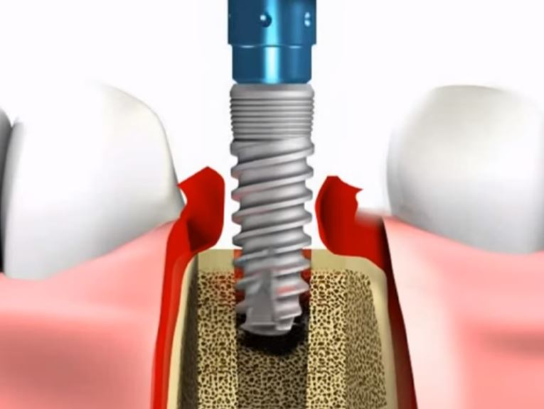 implantes dentales casher