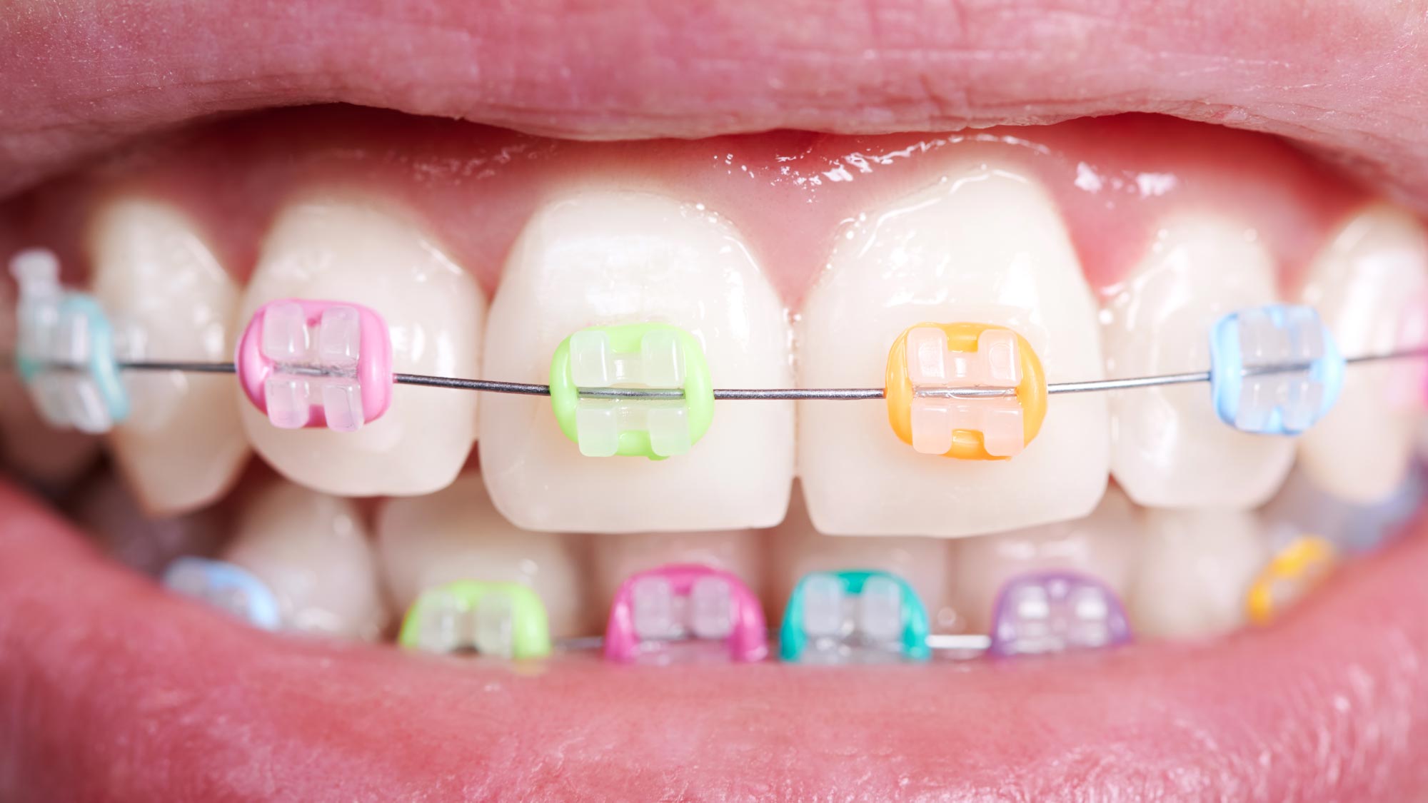 dientes blancos con ortodoncia fija de colores