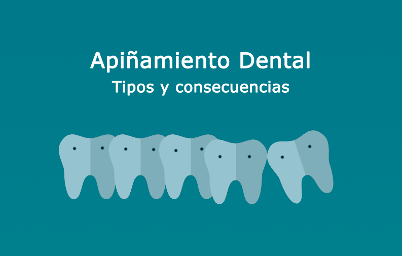 apiñamiento dental