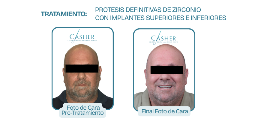 foto antes y despues de tratamiento de implantes