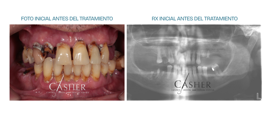 foto y radiografia inicial de tratamiento