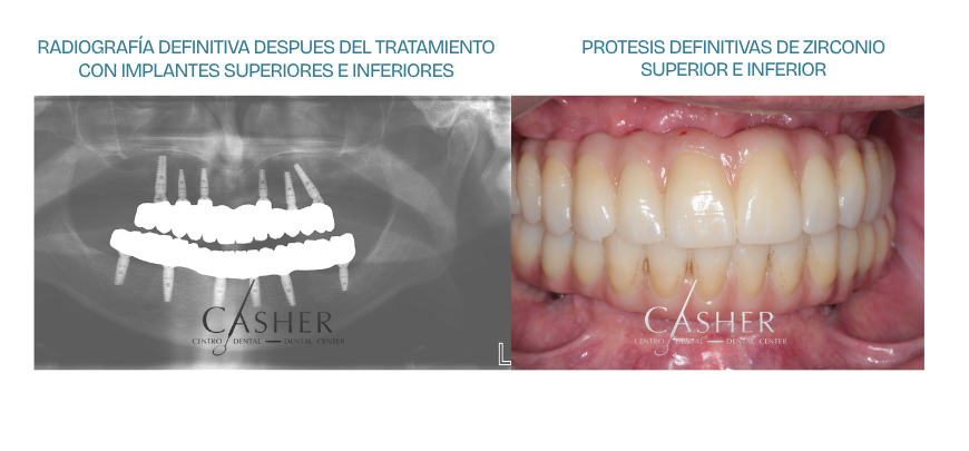 radiografia definitiva y foto final implantes