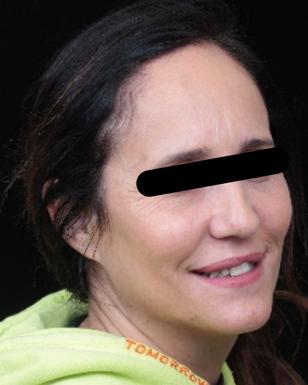 Estado inicial de la sonrisa antes de las carillas de cerámica - Casher Dental Alicante