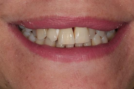 Dientes con espacios y desalineación antes del tratamiento estético - Casher Dental Alicante