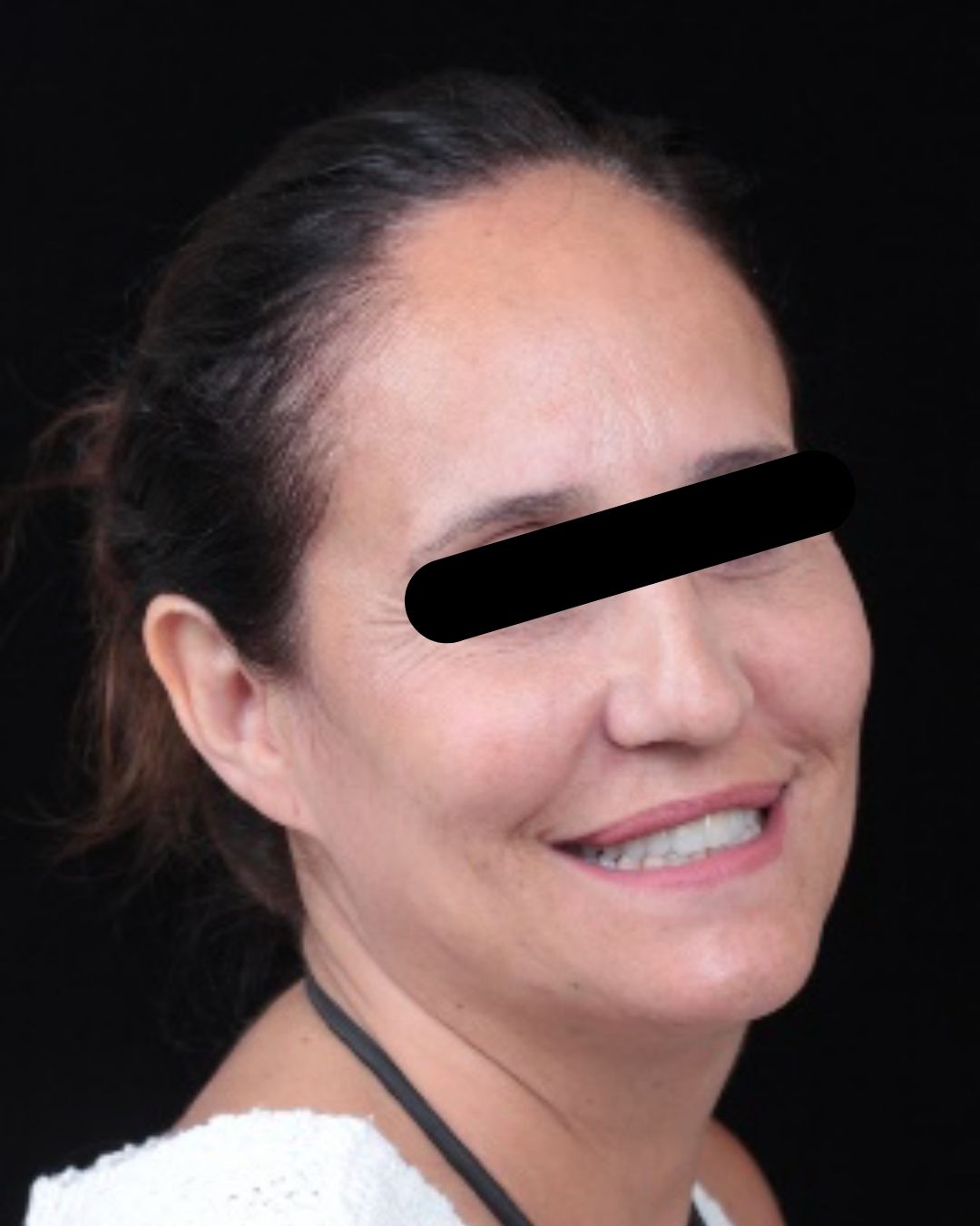 Resultado final tras carillas de cerámica - Casher Dental Alicante