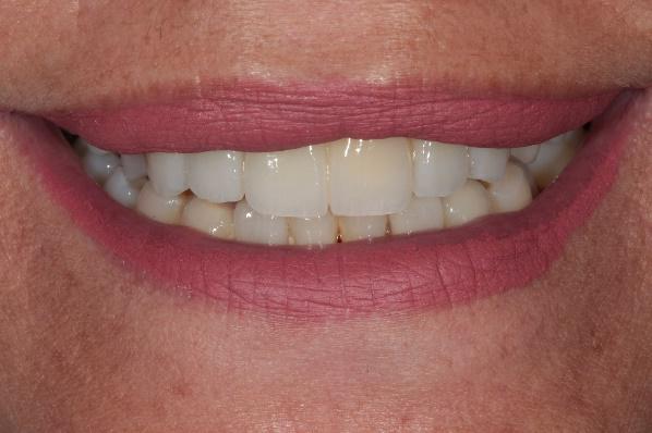 Sonrisa natural tras tratamiento estético sin implantes - Casher Dental Alicante