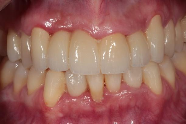 Antes y después carillas de cerámica clínica dental Alicante