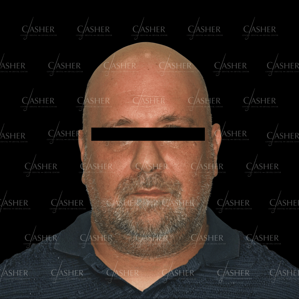 Estado inicial antes de la rehabilitación oral con implantes en Alicante