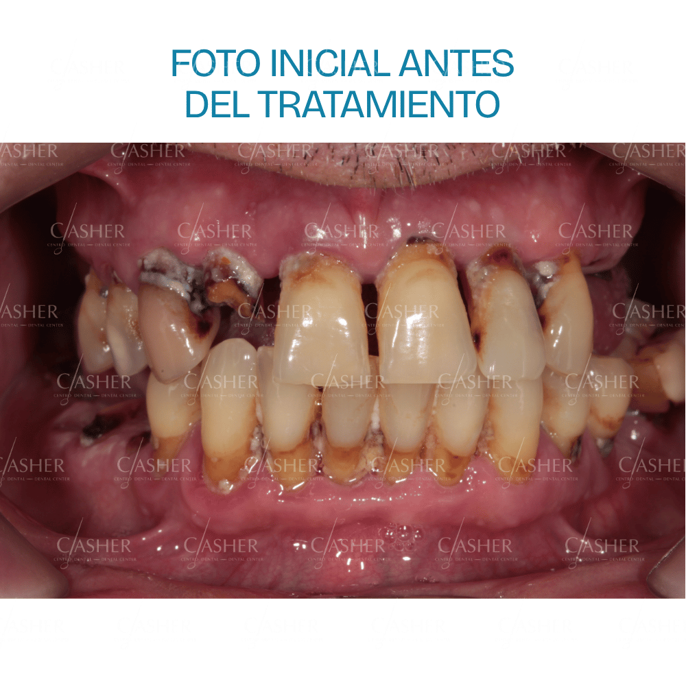 Fotografía previa al tratamiento de implantes dentales en Clínica Casher