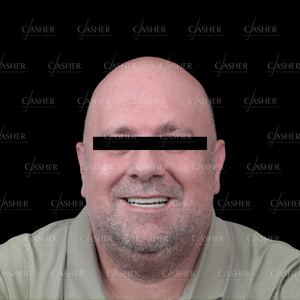  Resultado de rehabilitacion completa con implantes y zirconio