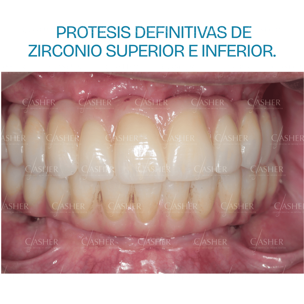 Prótesis fijas definitivas de zirconio sobre implantes