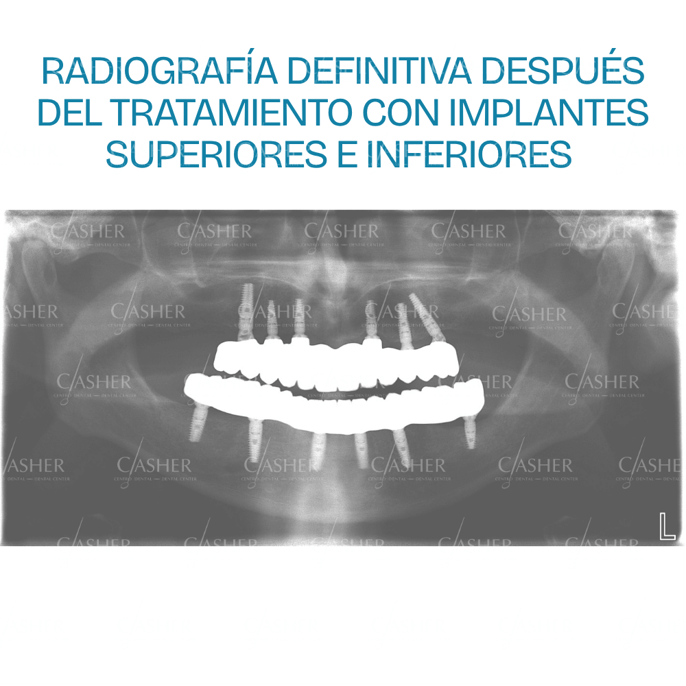 Sonrisa después del tratamiento de implantes dentales en Alicante