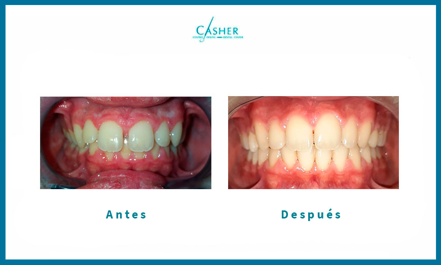 antes y despues tratamiento de ortodoncia