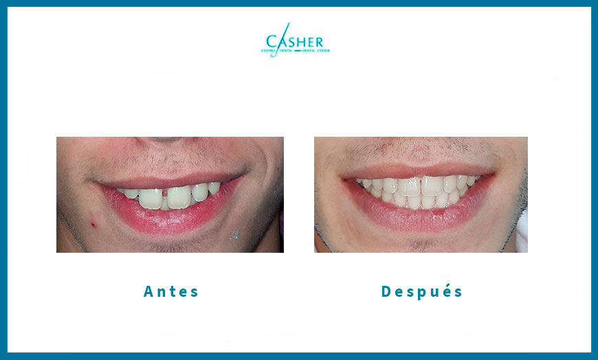 antes y despues ortodoncia brackets