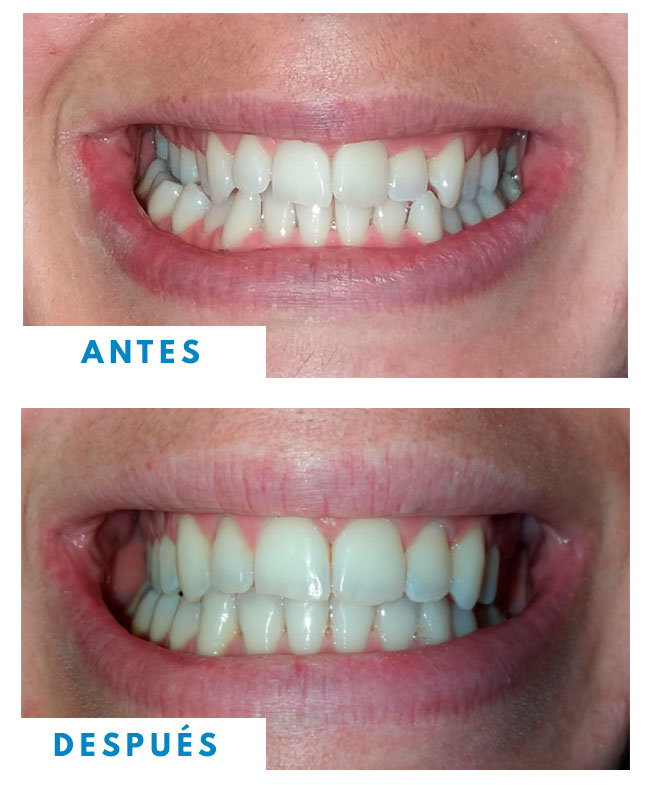 caso invisalign antes y despues