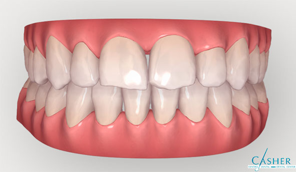 clincheck invisalign