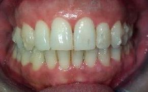 Paciente con ataches de INVISALIGN.