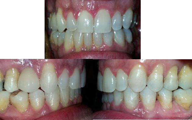 resultado tratamiento invisalign alicante