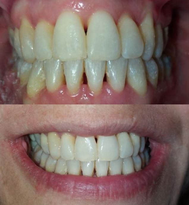 resultado final del tratamiento de ortodoncia con brackets y apiñamiento