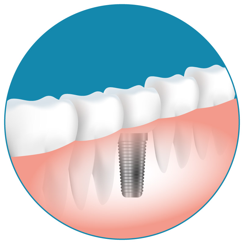 implantes dentales en Alicante