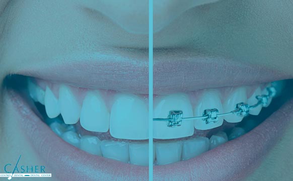 comparativa del tratamiento de ortodoncia normal con ortodoncia invisible